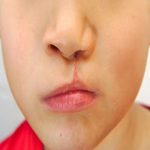 Cleft Palate Repair Surgery Cost