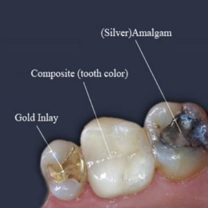 Teeth Filling Price in Pakistan