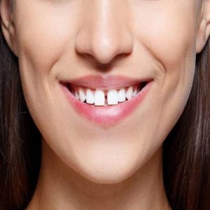 Teeth Gap Filling Cost in Islamabad