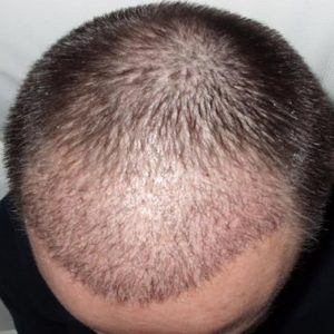 Hair Shedding After Hair Transplant