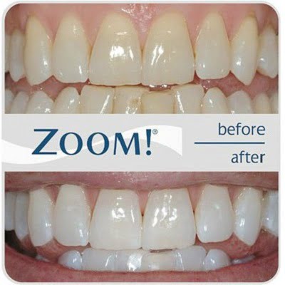 Zoom Teeth Whitening in Islamabad, Rawalpindi & Pakistan