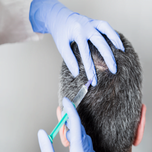PRP Treatment For Hair loss