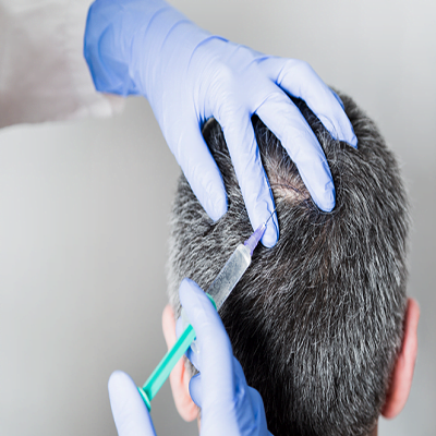 PRP Treatment For Hair loss Islamabad