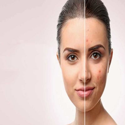 Scar Removal Islamabad