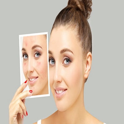 Acne Scar Treatment in Islamabad