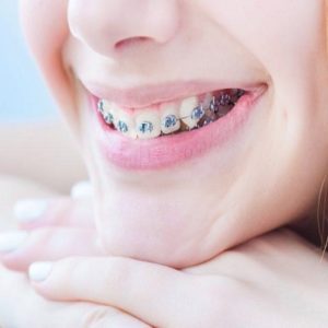 How Much Does It Cost To Have Braces?