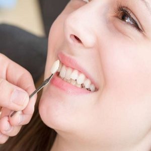 Important Things To Know Before Getting Dental Veneers