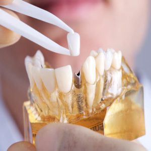 Dental Implants Surgery, Advantages Risk and Cost