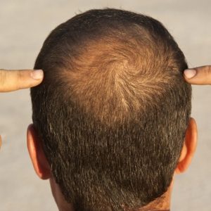 Which is The Best city For Hair Transplant in Pakistan?