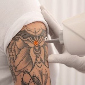 How Laser Tattoo Removal Works