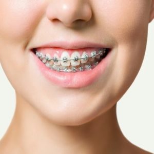 Teeth Braces Cost in Islamabad