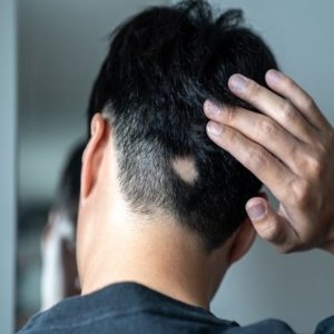 What Is The Best Solution For Alopecia?