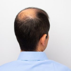 Is Baldness (Alopecia) a Treatable Problem?