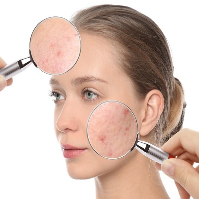 Best Acne Treatment in Islamabad