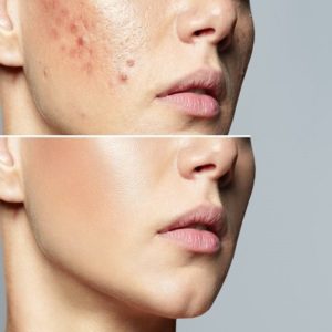 Choosing The Best Treatment For Acne Scar