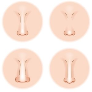 Different Methods of Rhinoplasty in Islamabad