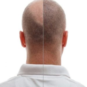 How Long Do Hair Implants Last?