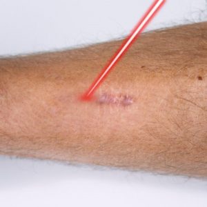 Laser Treatment For Scars On Legs