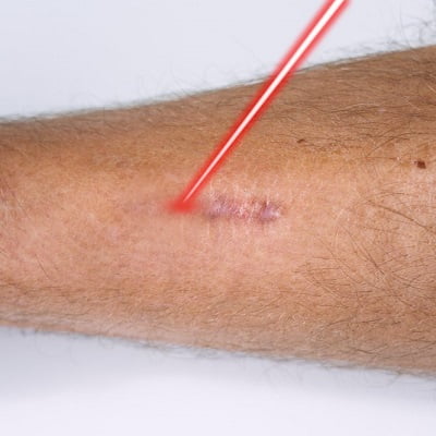 Laser Treatment For Scars On Legs in Islamabad