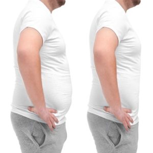 Liposuction Fat Removal Surgery in Islamabad