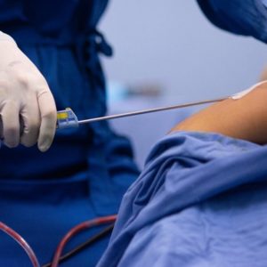 Revision liposuction in Islamabad