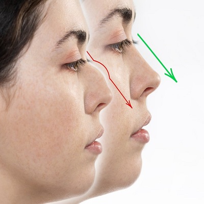 Rhinoplasty for Crooked Nose in Islamabad
