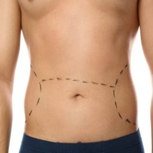 Tummy Tuck Cost in Pakistan