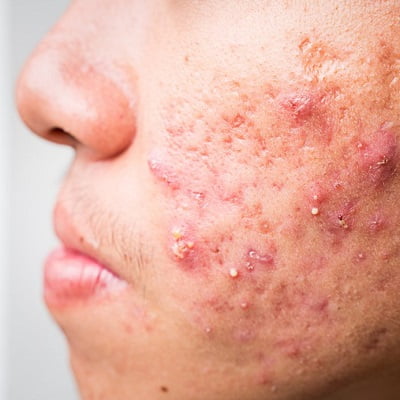 Acne scar treatment for brown skin in Islamabad