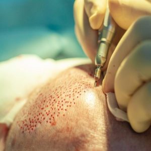 Baldness treatment for men in Islamabad