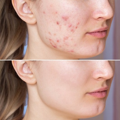 Best Dermatologist In Islamabad For Acne Scars