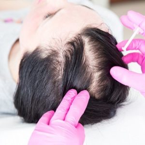 Best Options For Hair Loss Treatment