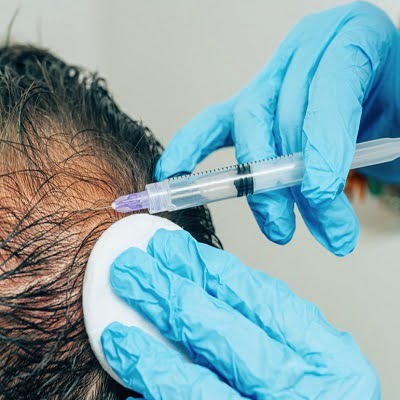 Best PRP hair treatment in Islamabad