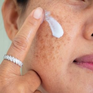 Best treatments For dark Spots on Face