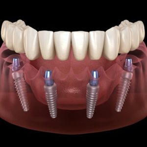 Dental implants benefits & cost in Islamabad