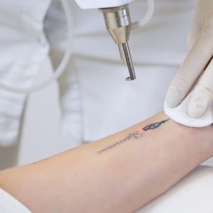 Does Laser Tattoo Removal Leave a Scar?