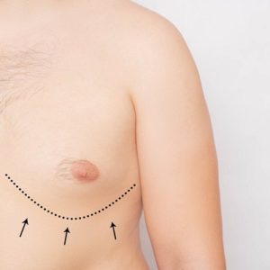 Do’s and Don’ts Before Gynecomastia Surgery