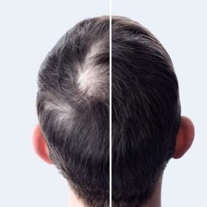 Which Hair Transplant Method is Best in Islamabad