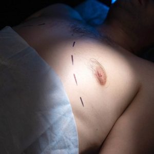 Lipo Chest Surgery Cost In Islamabad