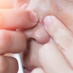 Nose Acne Scar Treatment in Islamabad