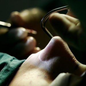 Nose Reshaping Cost in Pakistan