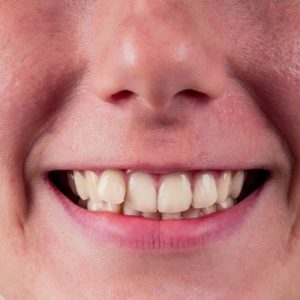 Overlapping Teeth Treatment Cost in Islamabad