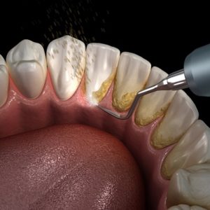 Tartar Removal Cost In Islamabad