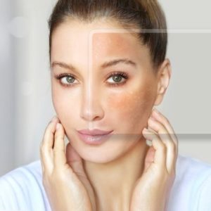 Can Pigmentation be Cured Permanently in Islamabad?