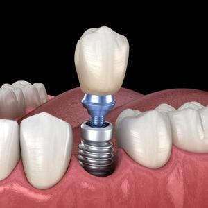 Everything You Need To Know About Dental Implant