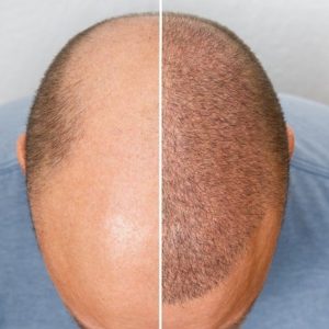 Hair Transplant Price Pakistan