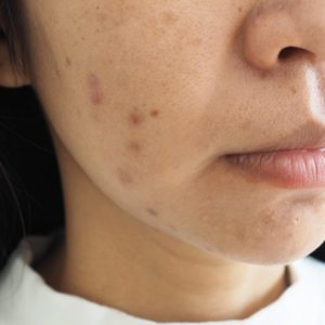 How To Get Rid of Dark Acne Scars?