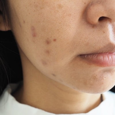 How To Get Rid of Dark Acne Scars