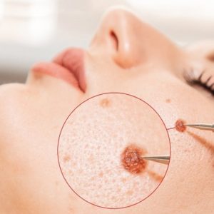 Is It Possible To Remove Warts Permanently?