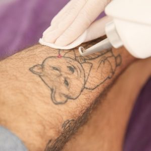 Laser Tattoo Removal on Legs in Islamabad