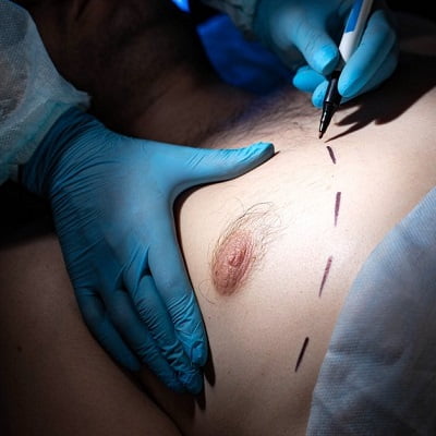 Liposuction For Gynecomastia In Islamabad